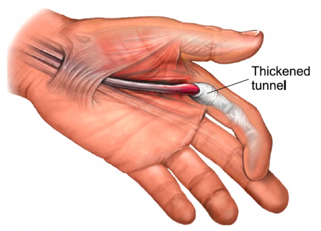 Trigger Finger – Fife Virtual Hand Clinic