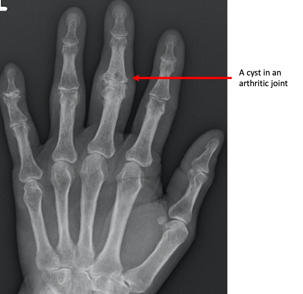 Bone Cyst Hand X Ray