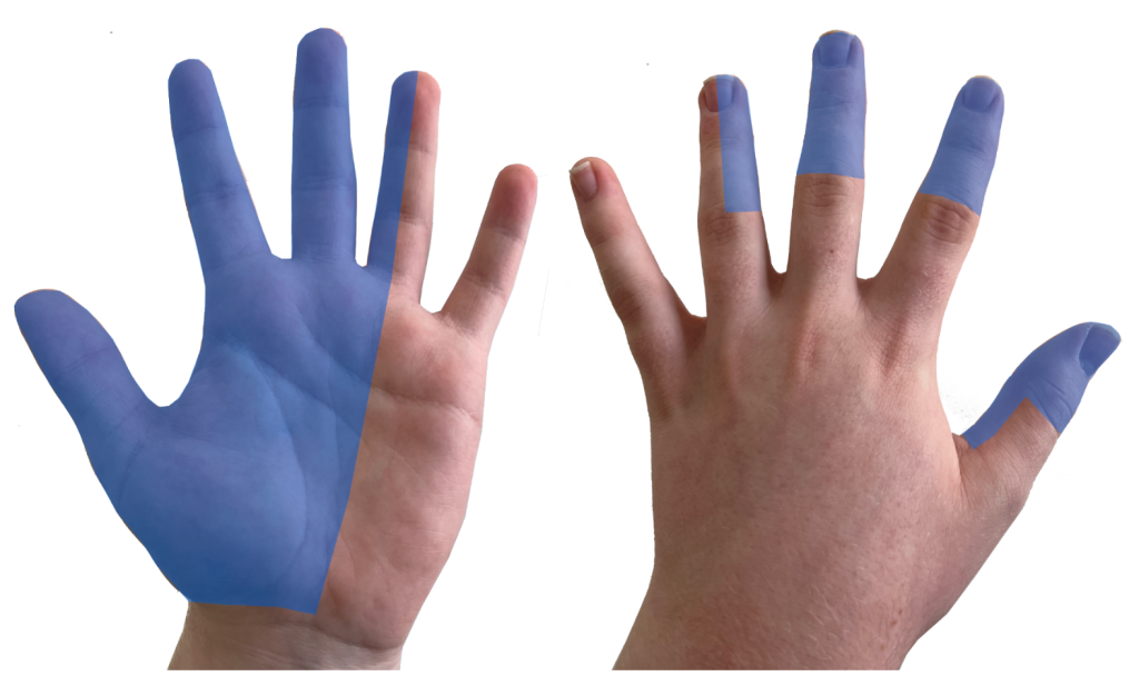 Carpal Tunnel Syndrome – Fife Virtual Hand Clinic